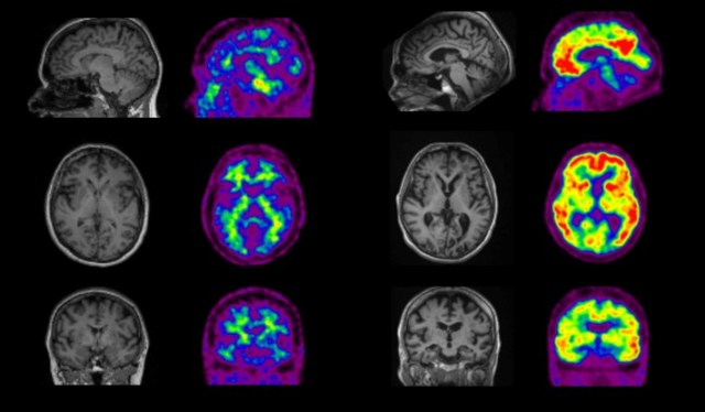 Australian dementia rates drop