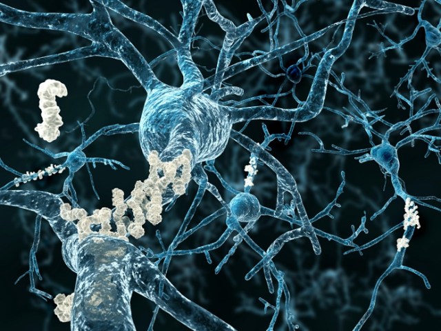 Alzheimer's disease - neurons with amyloid plaques